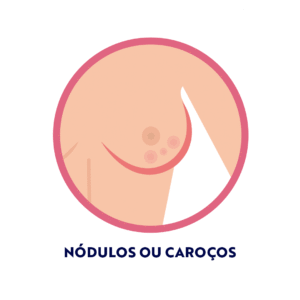 Nódulos ou caroços